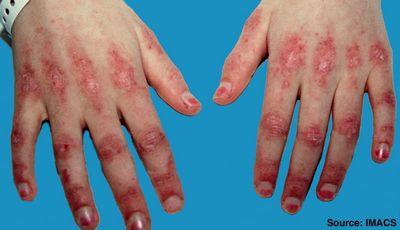 Dermatomyositis - ทำความเข้าใจกับอาการของมัน