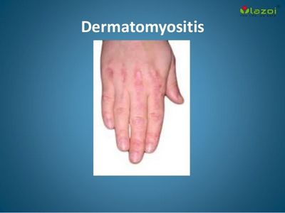 Dermatomyositis - ทำความเข้าใจกับอาการของมัน